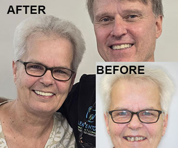 patient Before and after 006